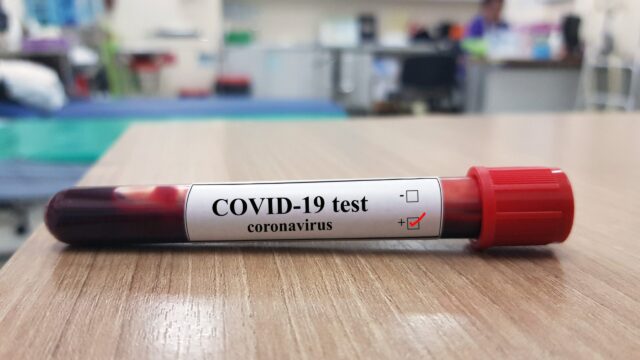 COVID-19: Nigeria records 573 new infections, 6 deaths COVID-19 test kits, COVID-19 cases, NCDC