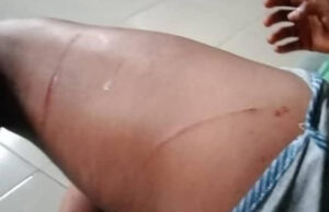 What #EndSARS protester macheted by hoodlums told Lagos panel