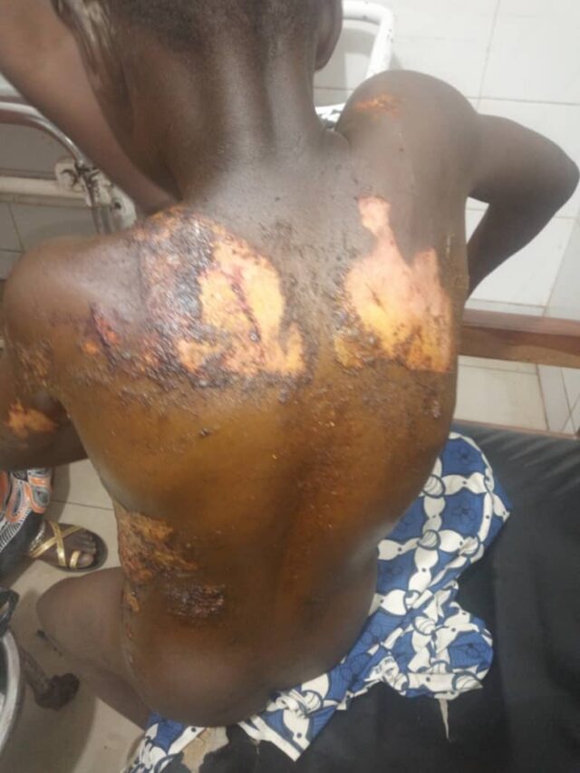 Woman undergoes psychiatric test for ‘bathing’ son with boiled water