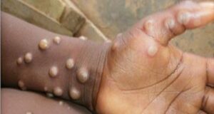 WHO raises the alarm as monkeypox spreads to Italy, Sweden Emergency, CITAD, NCDC, Monkeypox