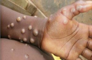 NCDC confirms 481 Monkeypox cases, 7 deaths Emergency, CITAD, NCDC, Monkeypox