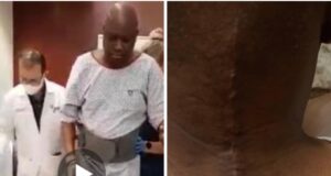 Fayose undergoes second surgery in 5 months Surgery