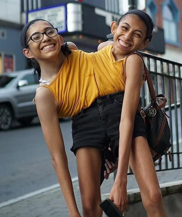 22-year-old conjoined twin sisters 22-year-old conjoined twin sisters