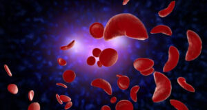 150,000 Nigerian children born with sickle cell gene annually — FG