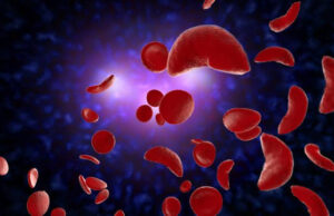 150,000 Nigerian children born with sickle cell gene annually — FG