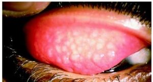Trachoma risk drops from 41m to 4m nationwide — FG