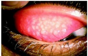 Trachoma risk drops from 41m to 4m nationwide — FG