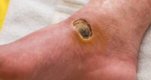 Niger confirms 11 Buruli ulcer cases