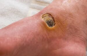 Niger confirms 11 Buruli ulcer cases