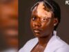 Woman shares heartbreak after vitiligo diagnosis