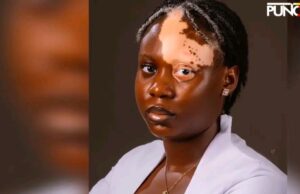 Woman shares heartbreak after vitiligo diagnosis