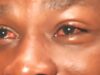 Apollo cases confirmed in Yobe as eye infection spreads