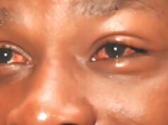 Apollo cases confirmed in Yobe as eye infection spreads