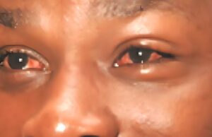 Apollo cases confirmed in Yobe as eye infection spreads