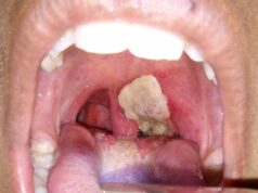 Diphtheria outbreak kills over 50 children in Kano