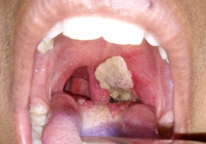 diphtheria-e1722382663264