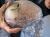 China approves brain implant to restore hand movement in paralysis patients
