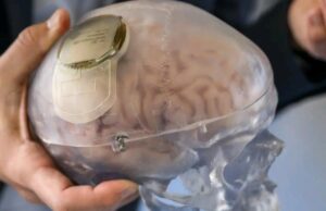 China approves brain implant to restore hand movement in paralysis patients